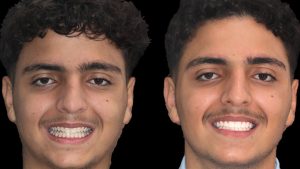 Ceramic Braces