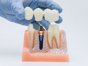 Dental Crown 