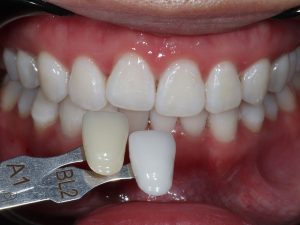 How Can You Tell If a Dental Veneer Needs Attention? 1 Dental Veneer