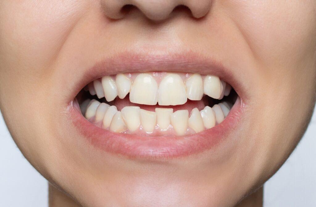 The Best Way to Fix Crooked Teeth