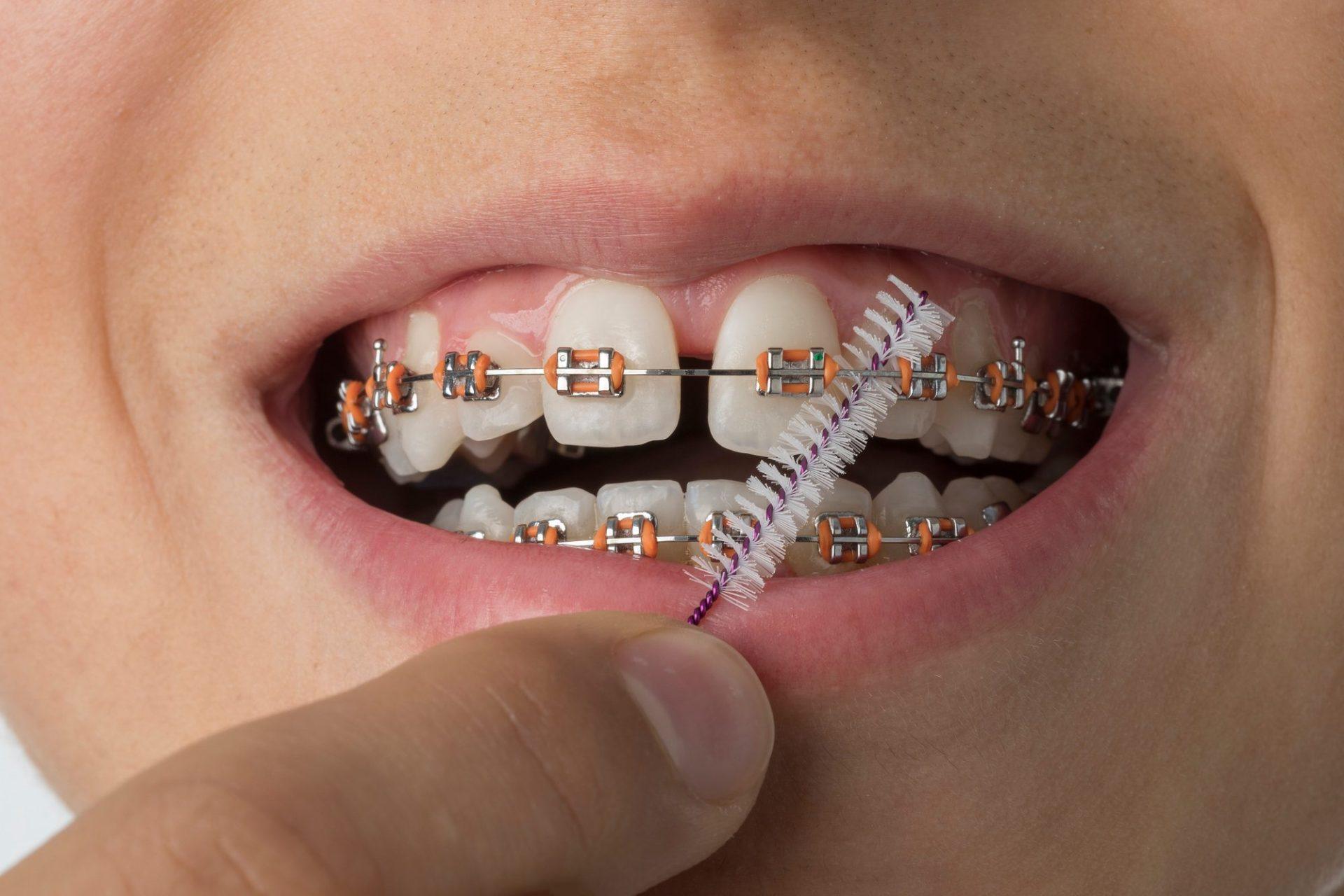 close up of cleaning dental braces