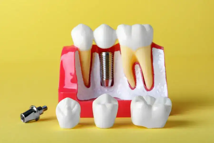 Tooth Implants 28 Signs You May Need Single Tooth Dental Implant