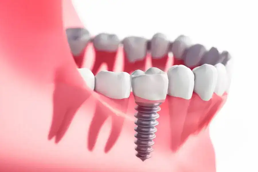 Education 32 Single Tooth Implants