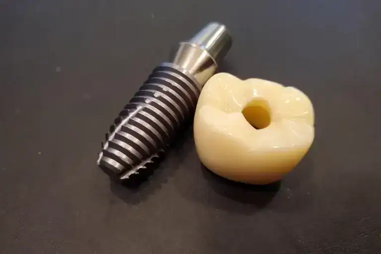 Tooth Implants 27 What Is a Single Tooth Implant