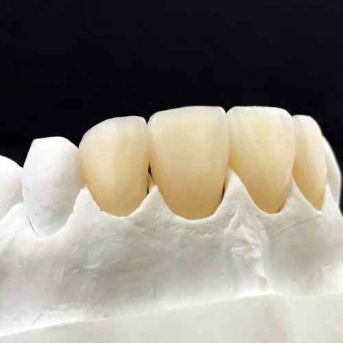 dental zirconia crowns in the plaster model white dental veneer r8e7ogoa4hy48gasjf25bgea3z0p34l2w2o3ts8k94