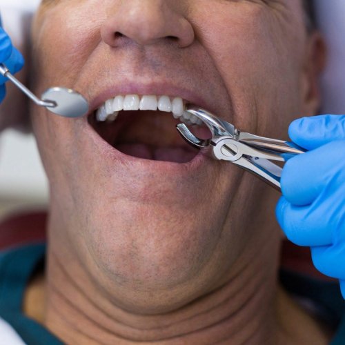 Teeth Extractions