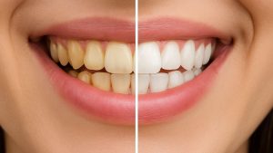 Teeth Whitening