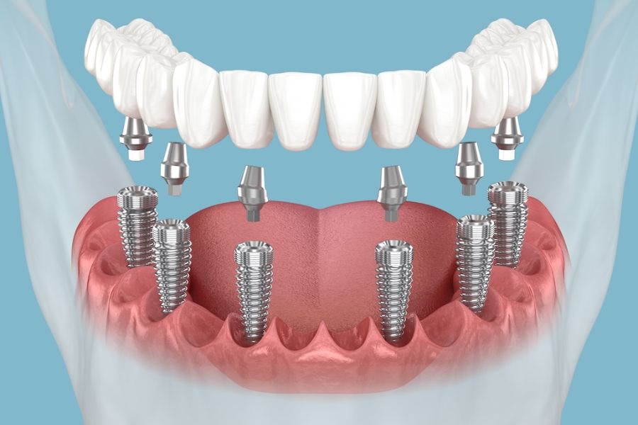 All on 6 Dental Implants 27 All on 6 Dental Implants