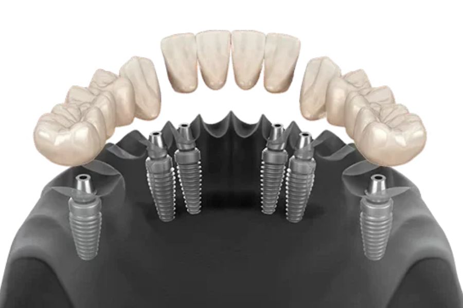 All on 6 Dental Implants 28 All on 6 Dental Implants