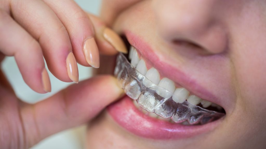 Close-up of a person inserting a clear aligner over their teeth