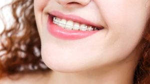 Ceramic Braces