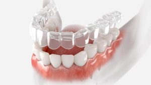 Clear Aligners