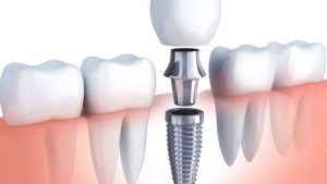 How Much Are Dental Implants Cost With Specialist Involvement? 1 Dental Implant -