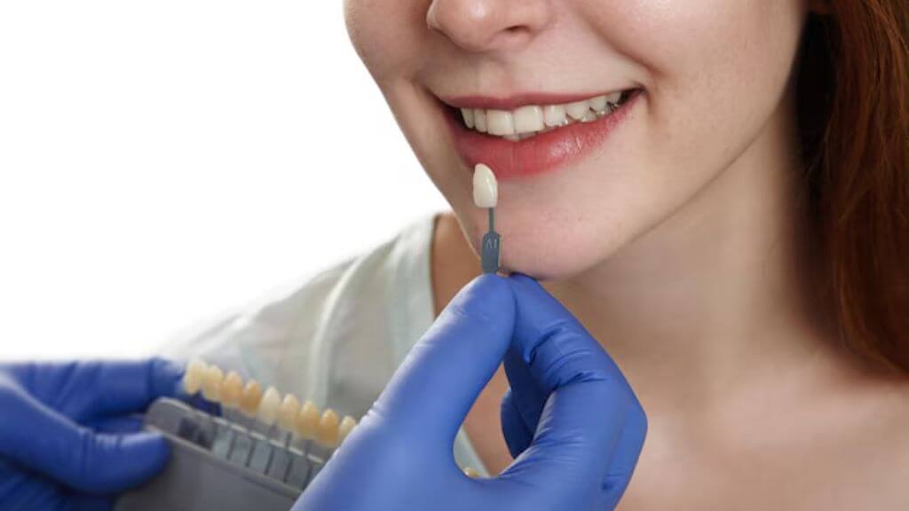 Education 37 Dental Veneers - Education