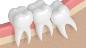 Teeth Extraction