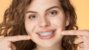 Ceramic Braces