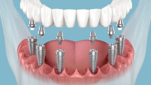 All-on 6 Dental Implants