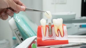 Dental Implants