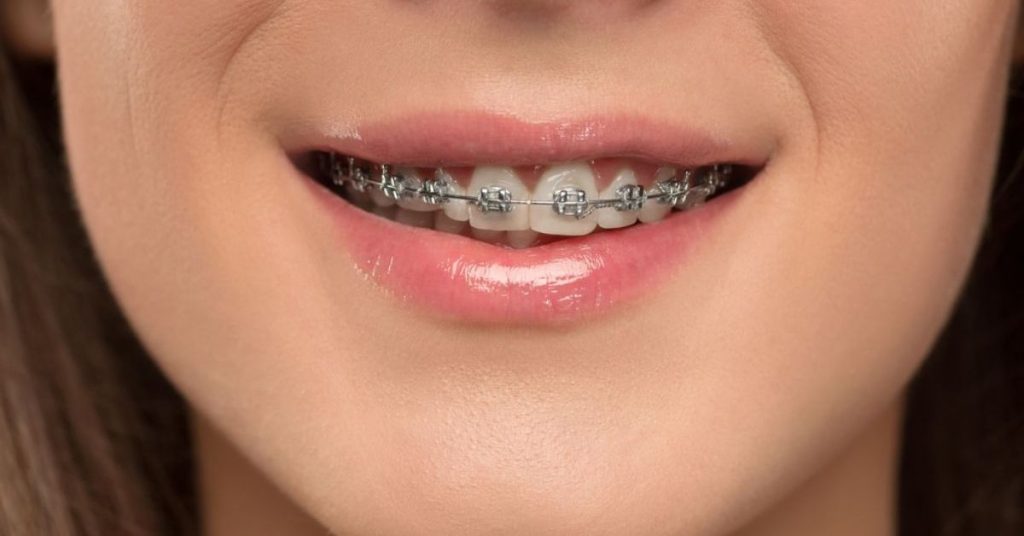 Education 27 Braces