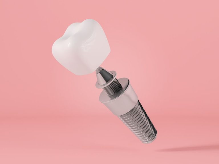 Dental Implants