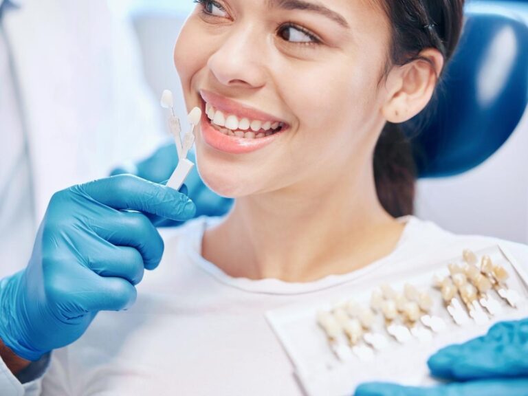 Composite Veneers