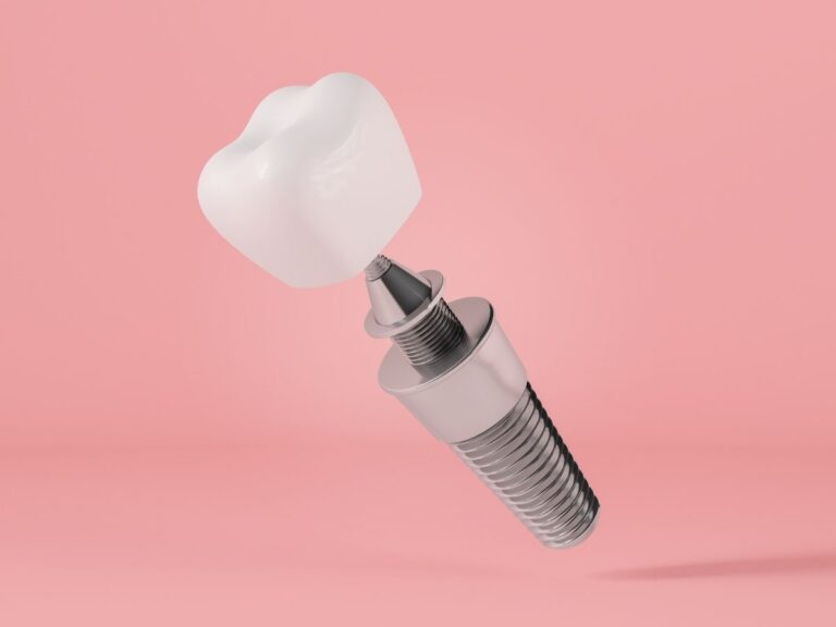 Single Tooth Implant