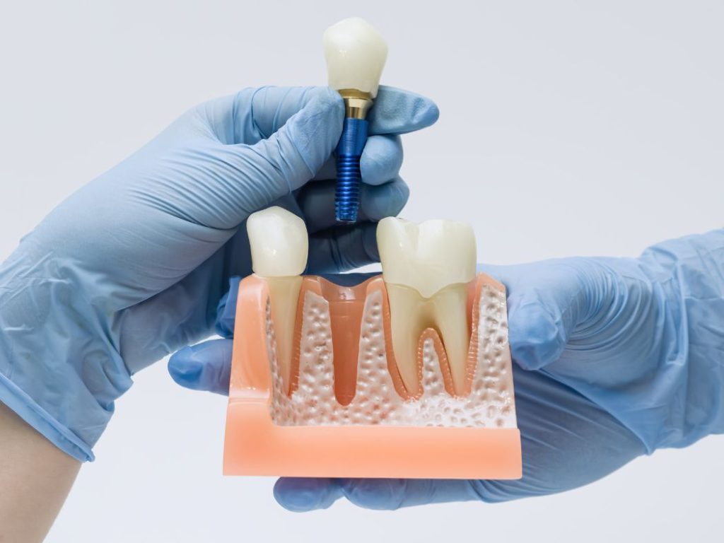 Dental Implants