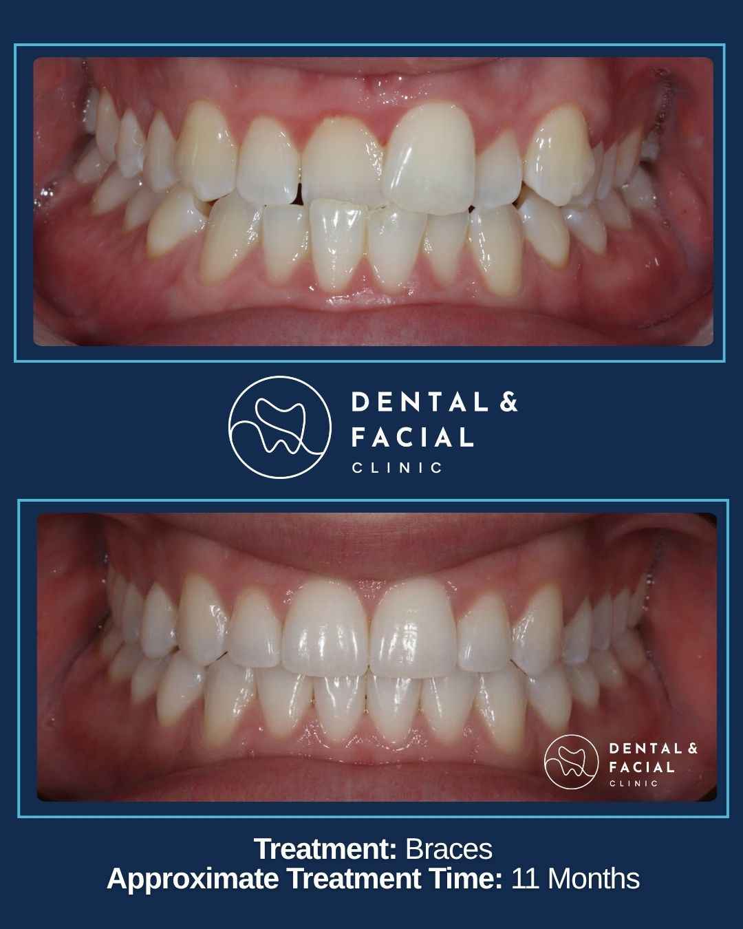 Braces