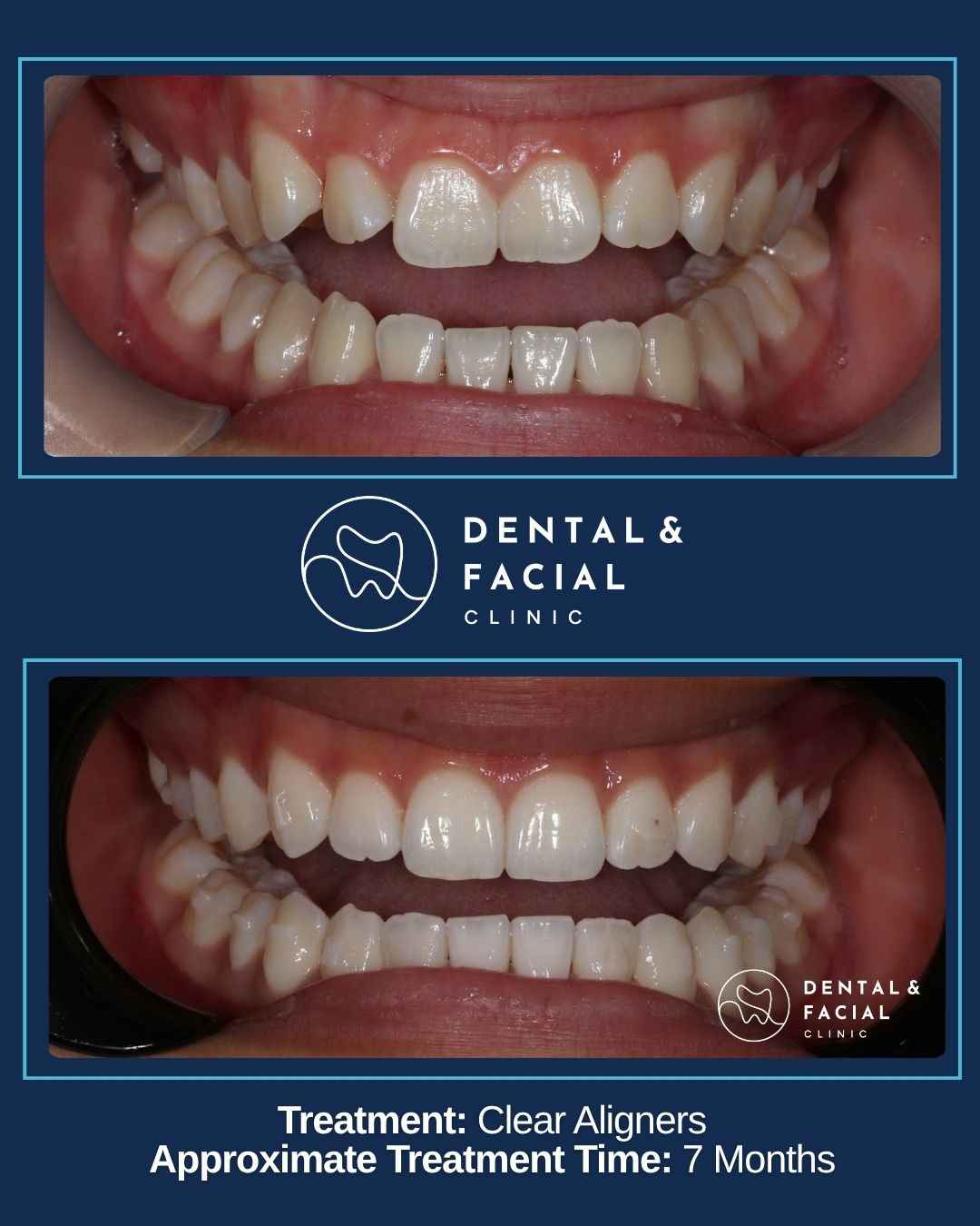 Clear Aligners