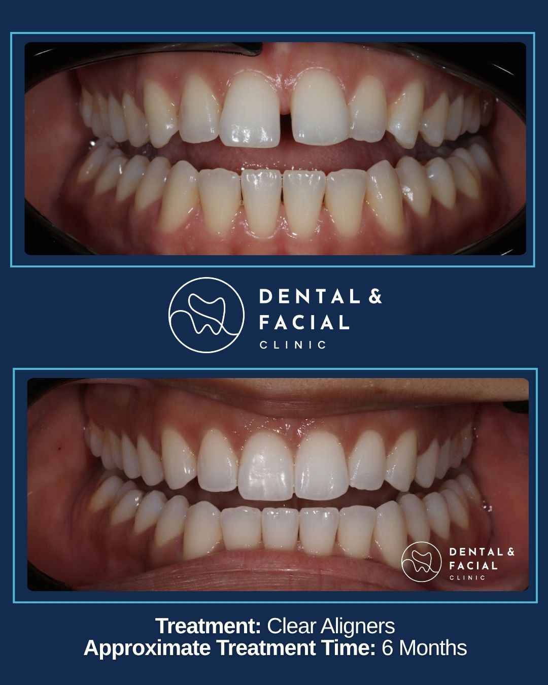 Clear Aligners