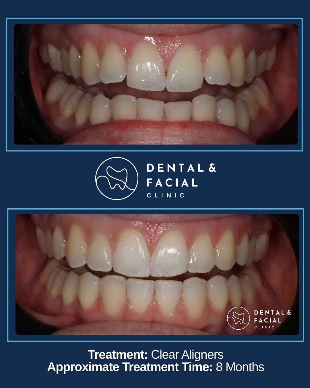 Clear Aligners