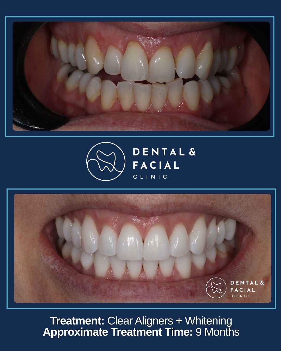 Clear Aligners+ Whitening