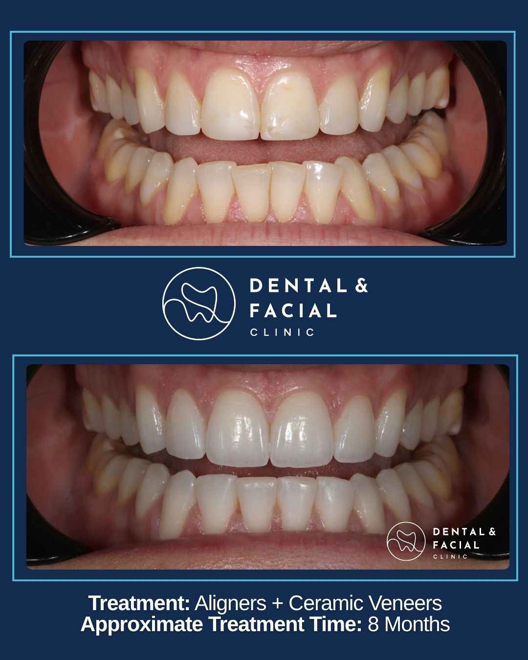 Clear Aligners+Ceramic Venees