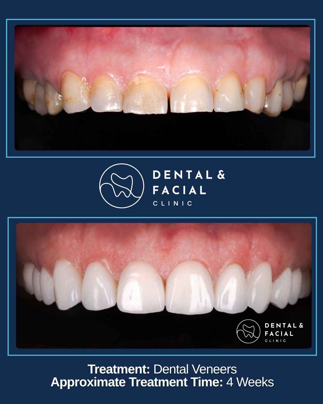 Dental Veneers