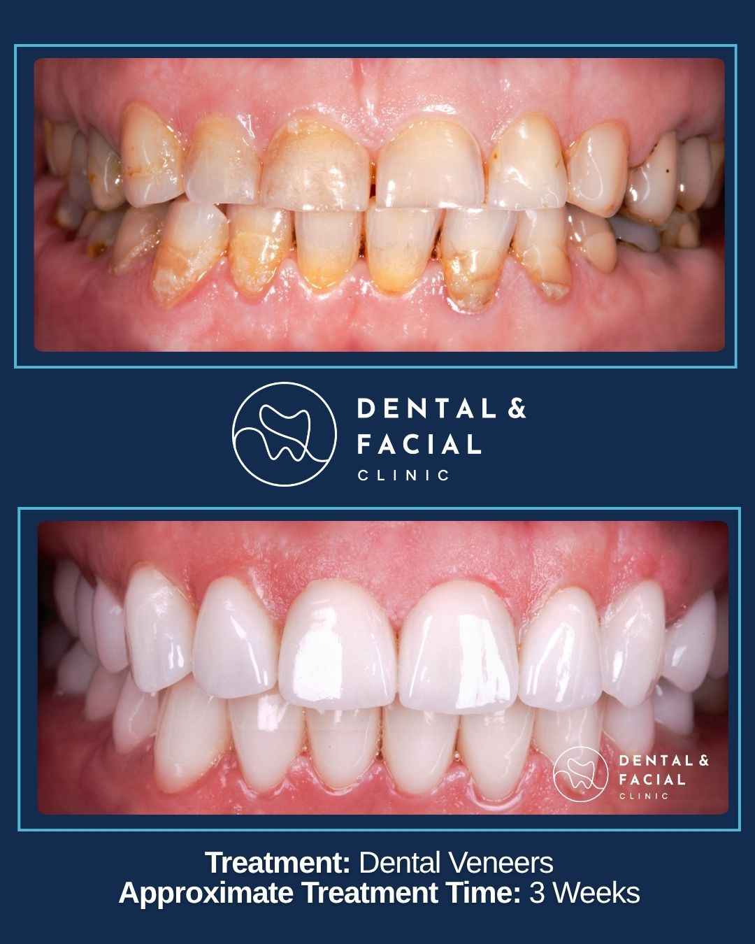 Dental Veneers