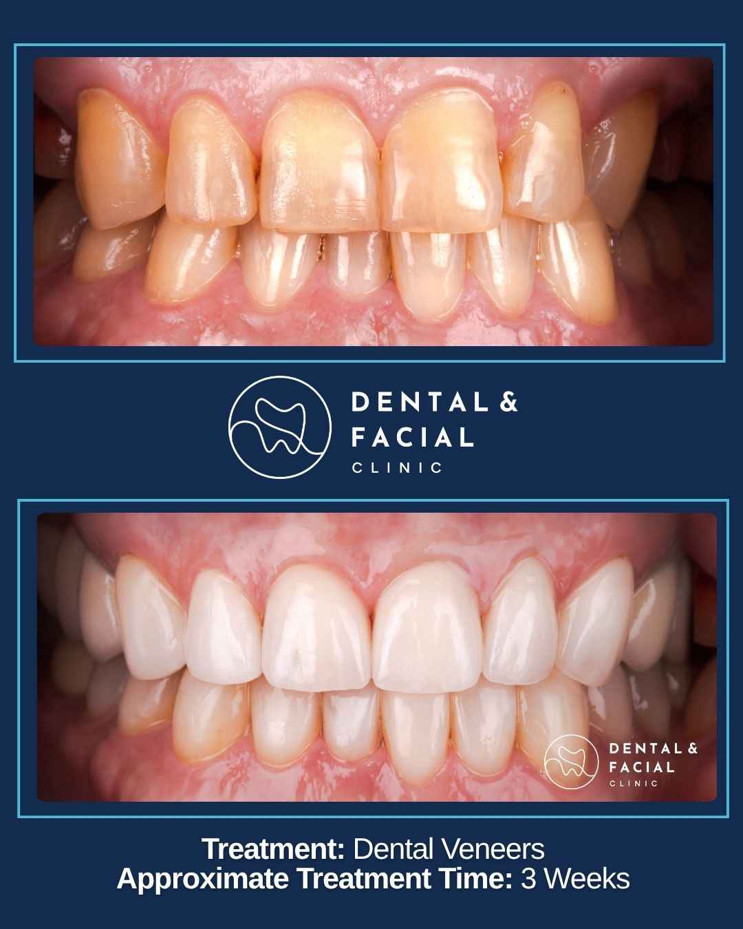 Dental Veneers