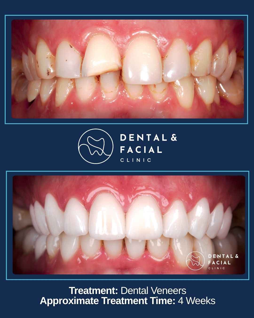 Dental Veneers