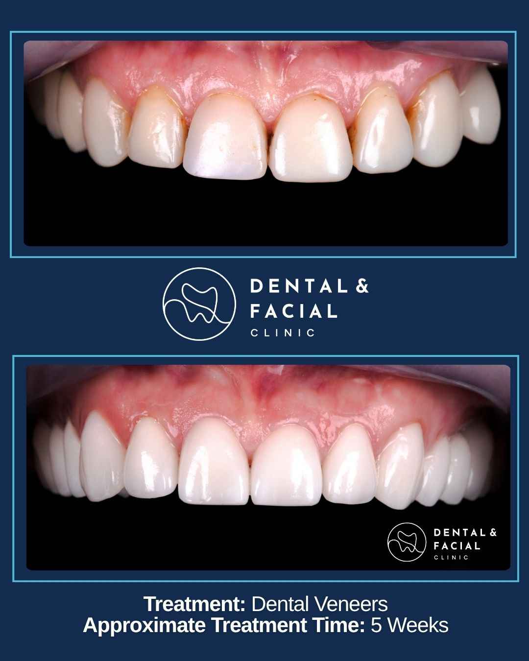 Dental Veneers
