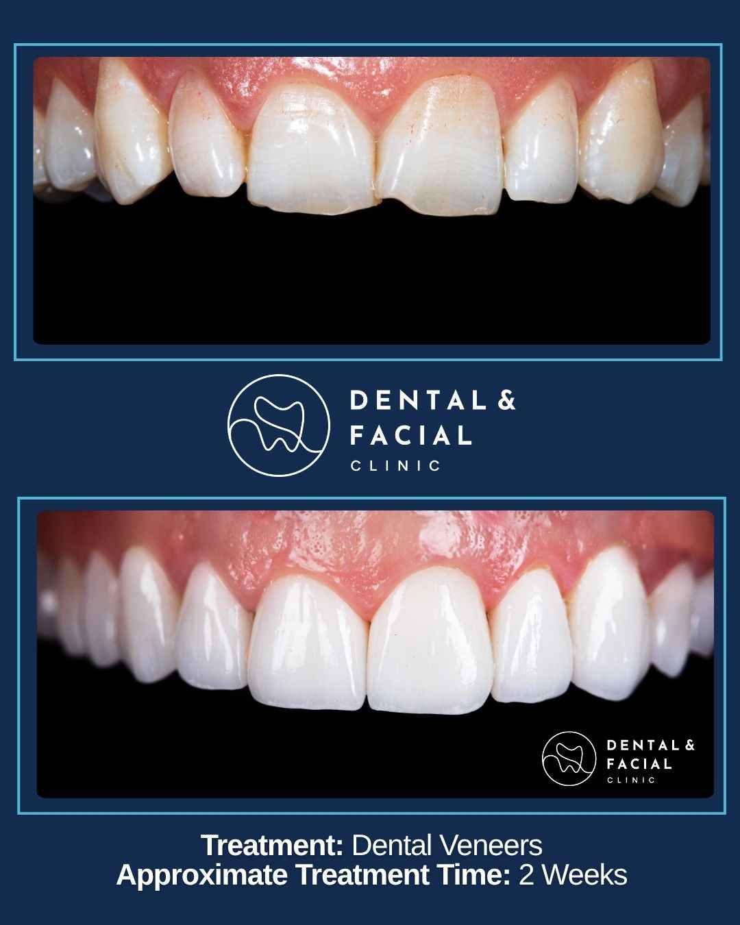 Dental Veneers