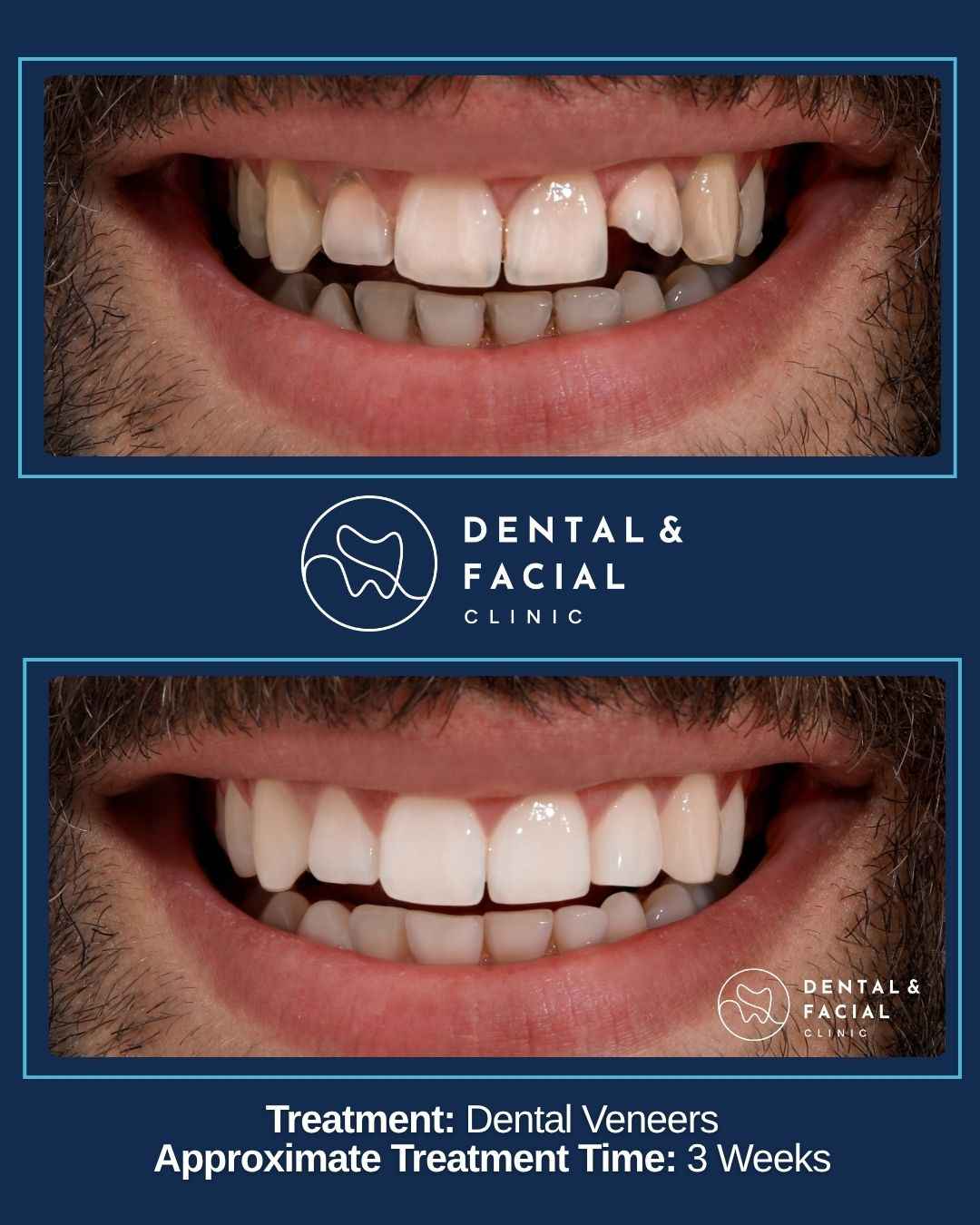 Dental Veneers