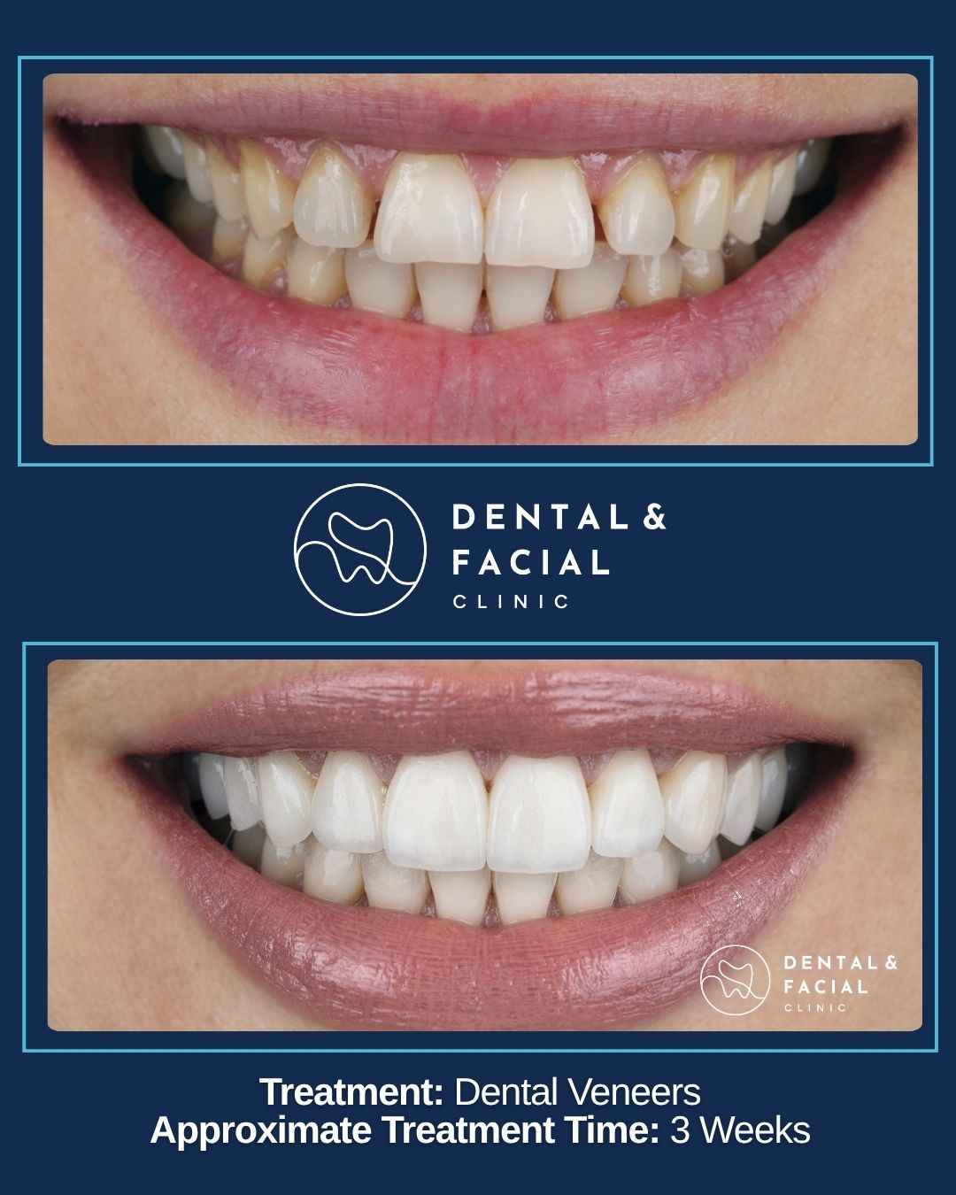 Dental Veneers