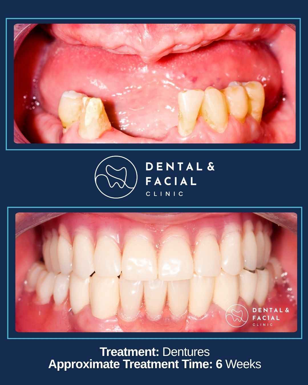 Dentures