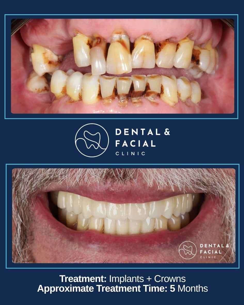 Implants + Crowns