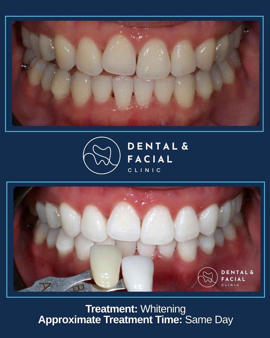Teeth Whitening