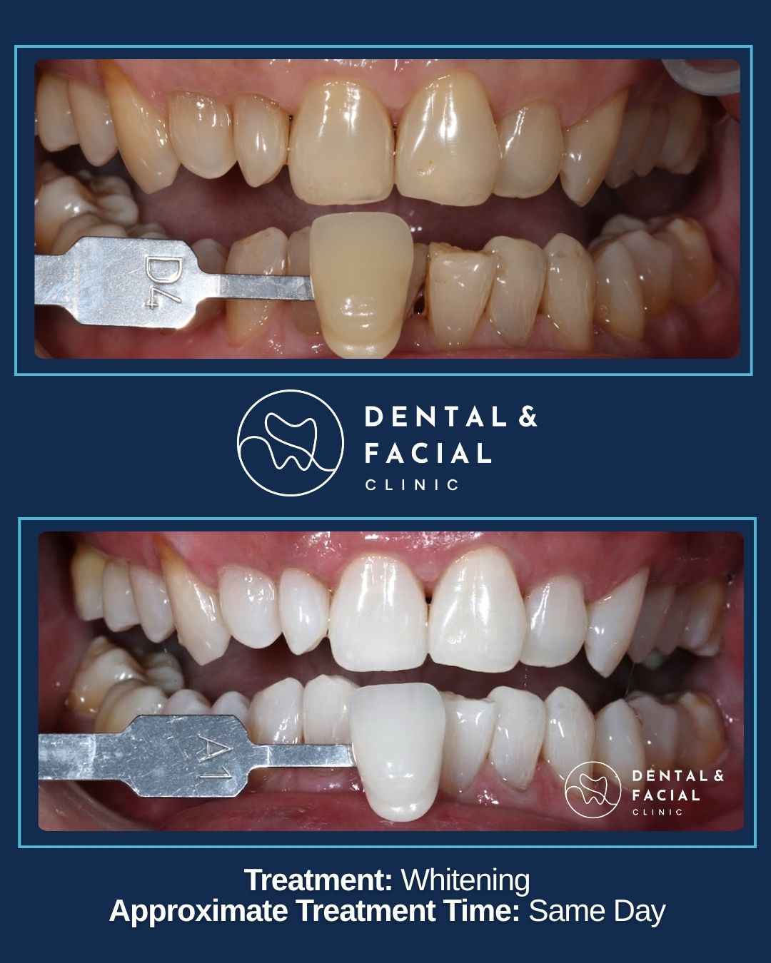 Teeth Whitening