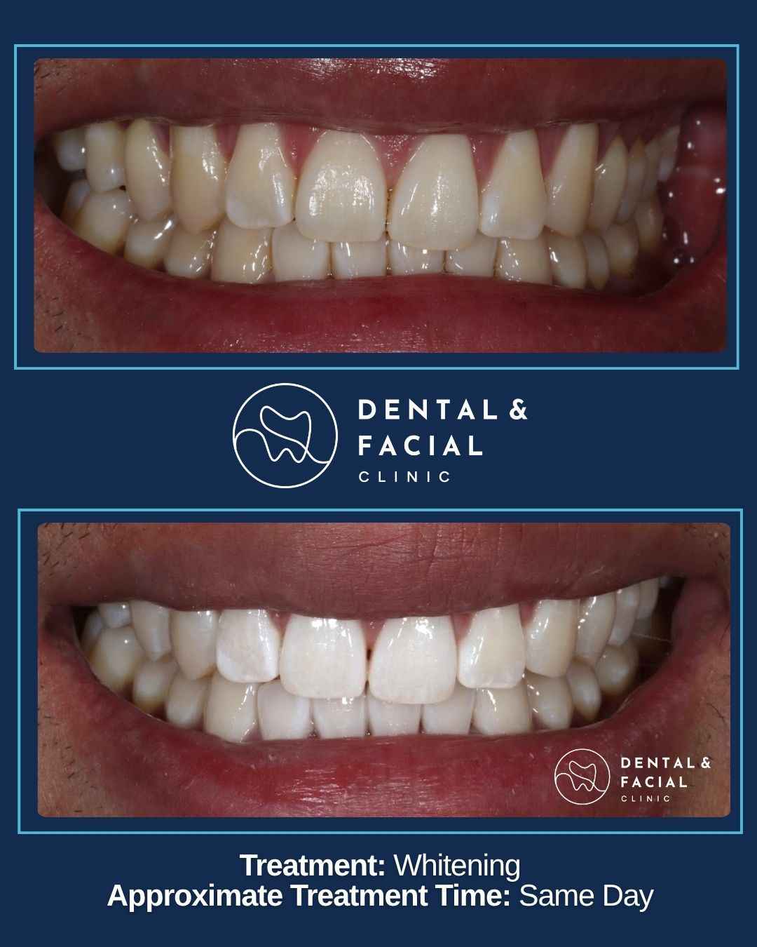 Teeth Whitening