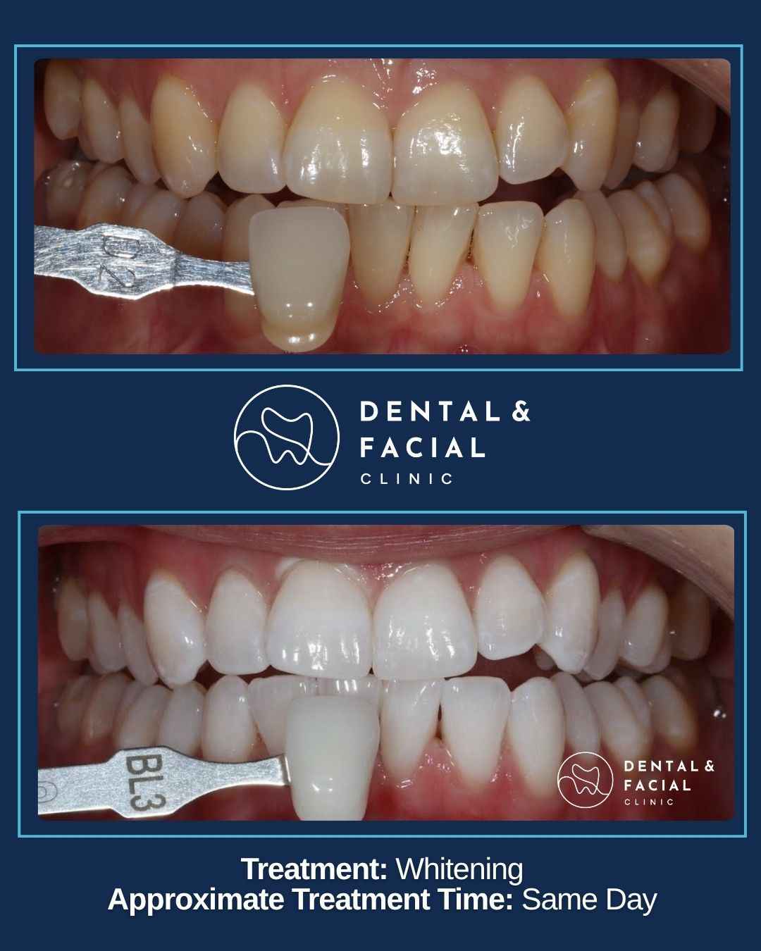 Teeth Whitening