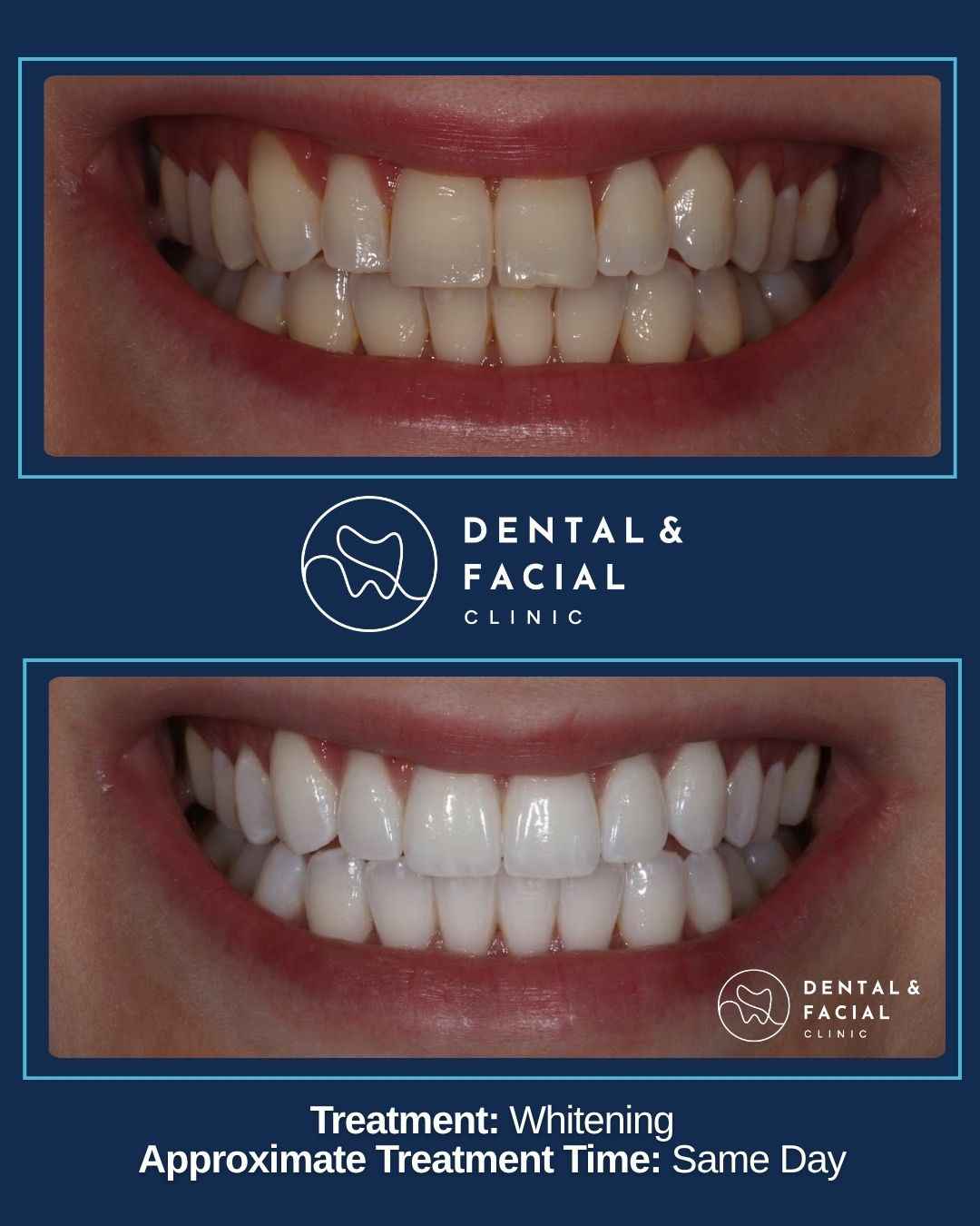 Teeth Whitening