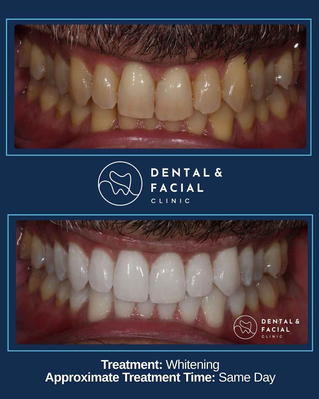 Teeth Whitening