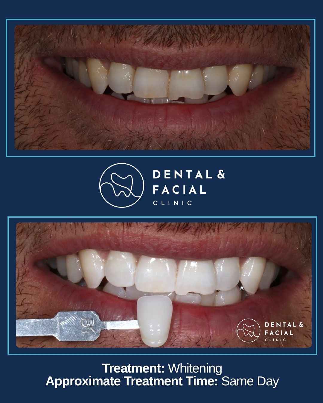 Teeth Whitening